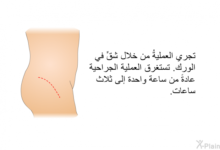 تجري العمليةُ من خلال شقٍّ في الورك. تستغرق العملية الجراحية عادةً من ساعة واحدة إلى ثلاث ساعات.