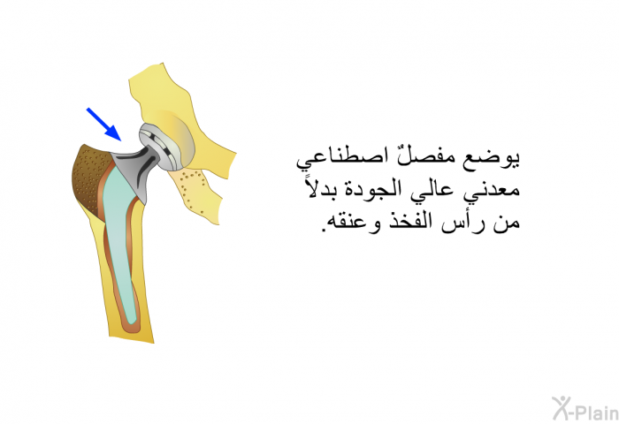 يوضع مفصلٌ اصطناعي معدني عالي الجودة بدلاً من رأس الفخد وعنقه.