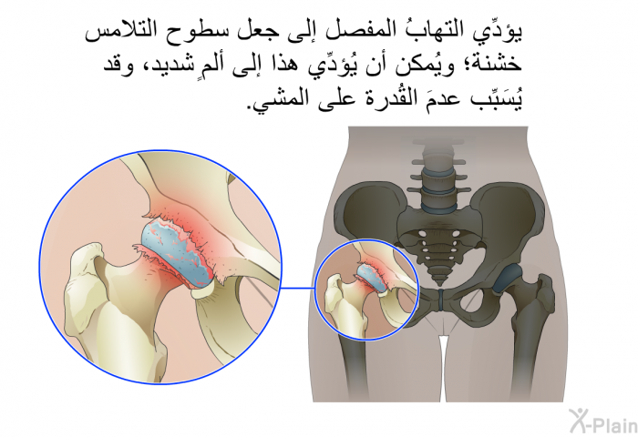 يؤدِّي التهابُ المفصل إلى جعل سطوح التلامس خشنة؛ ويُمكن أن يُؤدِّي هذا إلى ألمٍ شديد، وقد يُسَبِّب عدمَ القُدرة على المشي.