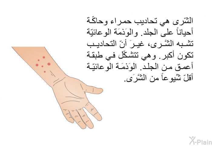 الشّرى هي تحاديب حمراء وحاكّة أحياناً على الجلد. والوَذمَة الوعائيّة تشبه الشَّرى، غيرَ أنّ التحاديب تكون أكبر. وهي تتشكّل في طبقة أعمق من الجلد. الوَذمَة الوعائيّة أقلّ شُيوعاً من الشَّرَى.