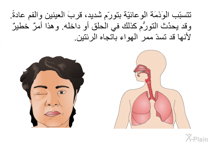 تتسبّب الوَذمَة الوعائيّة بتورّم شديد، قربَ العينين والفم عادةً. وقد يحدُث التورُّم كذلك في الحلق أو داخله. وهذا أمرٌ خطيرٌ لأنها قد تسدّ ممرّ الهواء باتجاه الرئتين.