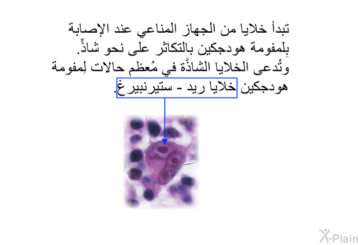 تبدأ خلايا من الجهاز المناعي عند الإصابة بِلمفومة هودجكين بالتكاثر على نحو شاذٍّ. وتُدعى الخلايا الشاذَّة في مُعظم حالات لِمفومة هودجكين خلايا ريد - ستيرنبيرغ.