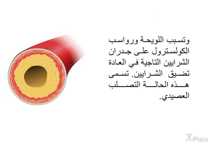 وتسبب اللويحة ورواسب الكولسترول على جدران الشرايين التاجية في العادة تضيق الشرايين. تسمى هذه الحالة التصلب العصيدي.