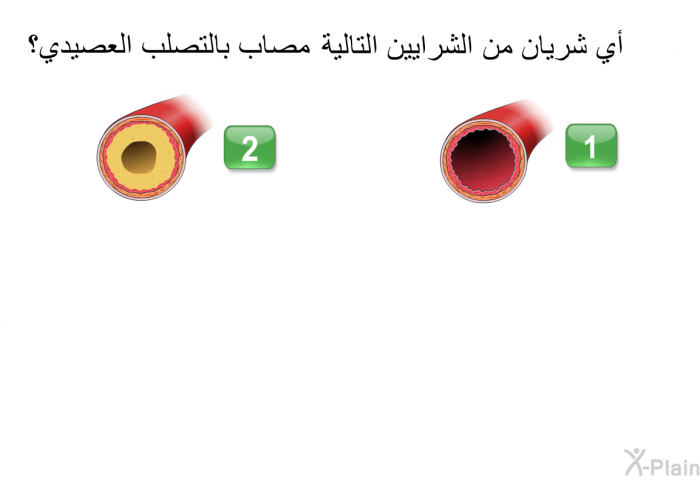 أي شريان من الشرايين التالية مصاب بالتصلب العصيدي؟