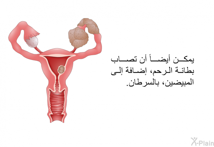 يمكن أيضاً أن تصاب بطانة الرحم، إضافة إلى المبيضين، بالسرطان<B>. </B>