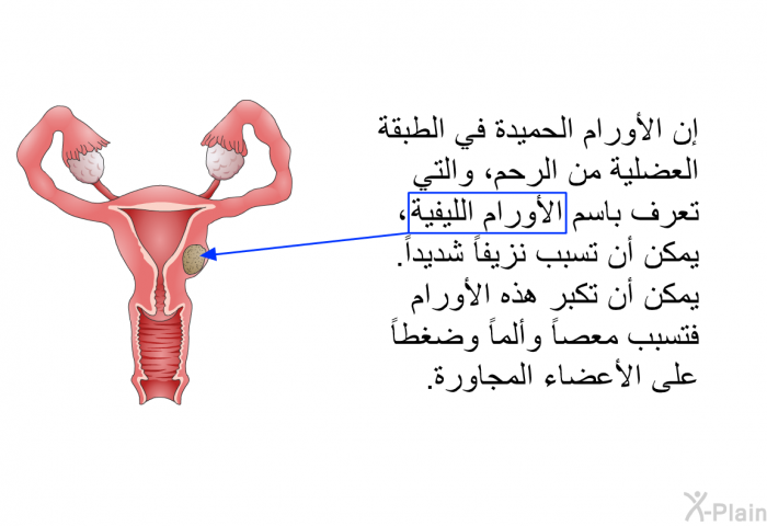 إن الأورام الحميدة في الطبقة العضلية من الرحم، والتي تعرف باسم الأورام الليفية، يمكن أن تسبب نزيفاً شديداً. يمكن أن تكبر هذه الأورام فتسبب معصاً وألماً وضغطاً على الأعضاء المجاورة.