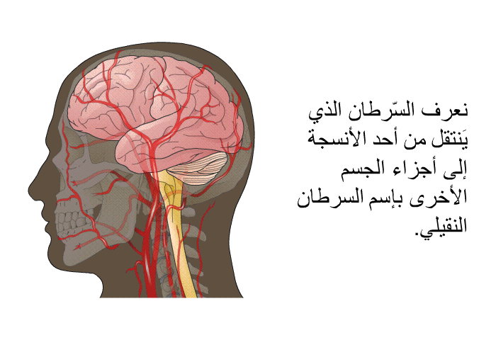 نعرف السّرطان الذي يَنتقل من أحد الأنسجة إلى أجزاء الجسم الأخرى بإسم السرطان النقيلي.