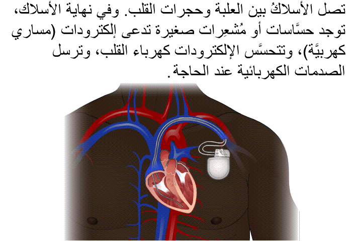 تصل الأسلاكُ بين العلبة وحجرات القلب. وفي نهاية الأسلاك، توجد حسَّاسات أو مُشعِرات صغيرة تدعى إلكترودات (مساري كهربيَّة)، وتتحسَّس الإلكترودات كهرباء القلب، وترسل الصدمات الكهربائية عند الحاجة.