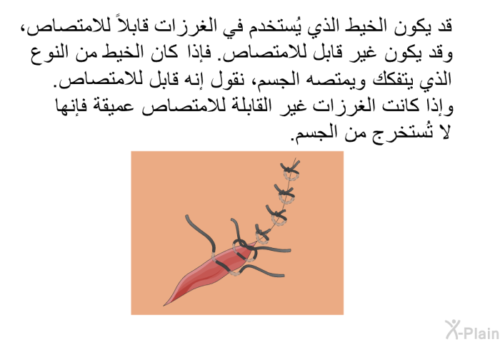 قد يكون الخيط الذي يُستخدم في الغرزات قابلاً للامتصاص، وقد يكون غير قابل للامتصاص. فإذا كان الخيط من النوع الذي يتفكك ويمتصه الجسم، نقول إنه قابل للامتصاص. وإذا كانت الغرزات غير القابلة للامتصاص عميقة فإنها لا تُستَخْرَج من الجسم.