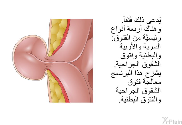 يُدعى ذلك فَتقاً. وهناك أربعةُ أنواع رئيسيَّة من الفتوق: السُّرِّية والأُربيَّة والبَطنية وفُتوق الشقوق الجراحية. تشرح هذه المعلومات الصحية معالجةَ فُتوق الشقوق الجراحية والفتوق البطنية.