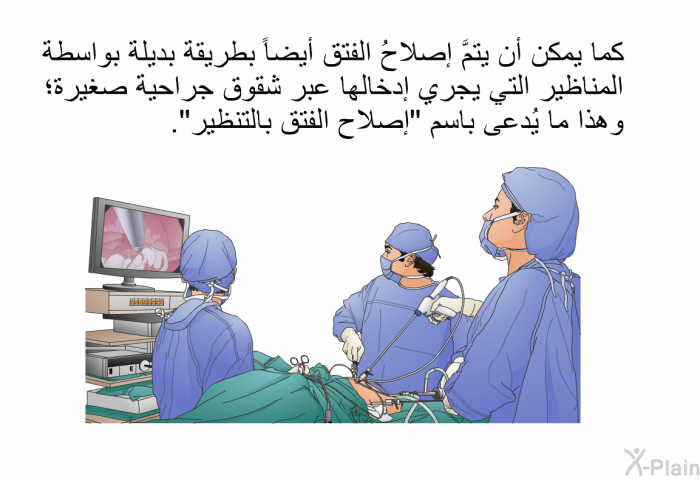 كما يمكن أن يتمَّ إصلاحُ الفتق أيضاً بطريقة بديلة بواسطة المناظير التي يجري إدخالُها عبر شقوق جراحية صغيرة؛ وهذا ما يُدعى باسم "إصلاح الفتق بالتنظير".