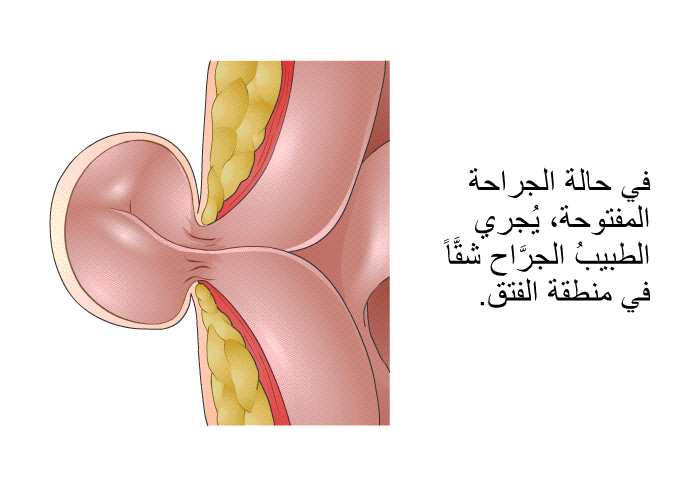 في حالة الجراحة المفتوحة، يُجري الطبيبُ الجرَّاح شقَّاً في منطقة الفتق.