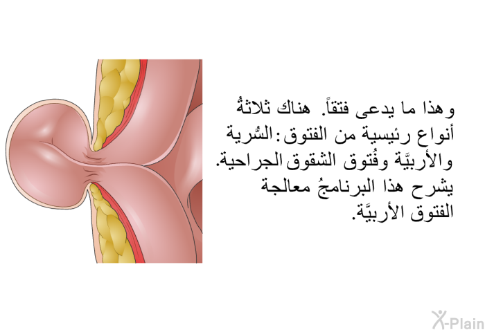 وهذا ما يدعى فتقاً. هناك ثلاثةُ أنواع رئيسية من الفتوق: السُّرية والأربيَّة وفُتوق الشقوق الجراحية. يشرح هذا البرنامجُ معالجة الفتوق الأربيَّة.