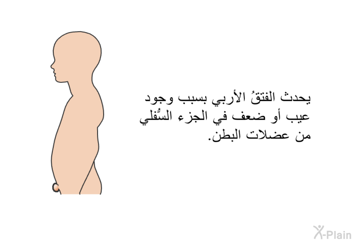 يحدث الفتقُ الأربي بسبب وجود عيب أو ضعف في الجزء السُّفلي من عضلات البطن.