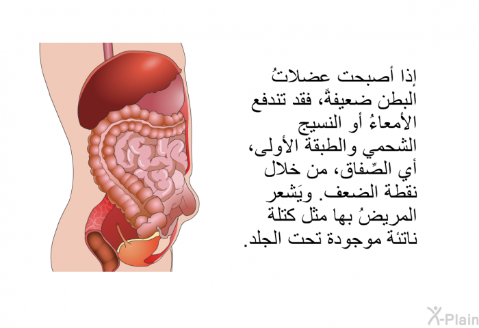 إذا أصبحت عضلاتُ البطن ضعيفةً، فقد تندفع الأمعاءُ أو النسيج الشحمي والطبقة الأولى، أي الصِّفاق، من خلال نقطة الضعف. ويَشعر المريضُ بها مثل كتلة ناتئة موجودة تحت الجلد.