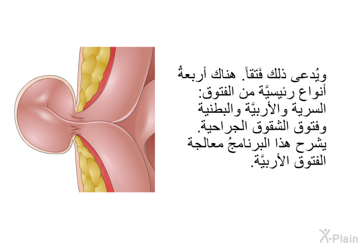 ويُدعى ذلك فَتقاً. هناك أربعةُ أنواع رئيسيَّة من الفتوق: السُّرِّية والأُربيَّة والبَطنية وفُتوق الشقوق الجراحية. تشرح هذه المعلومات الصحية معالجة الفتوق الأُربيَّة.