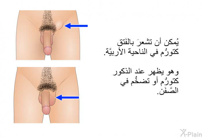 يُمكن أن تشعرَ بالفَتق كتورُّم في الناحية الأُربيَّة. وهو يظهر عند الذكور كتورُّم أو تضخُّم في الصَّفَن.