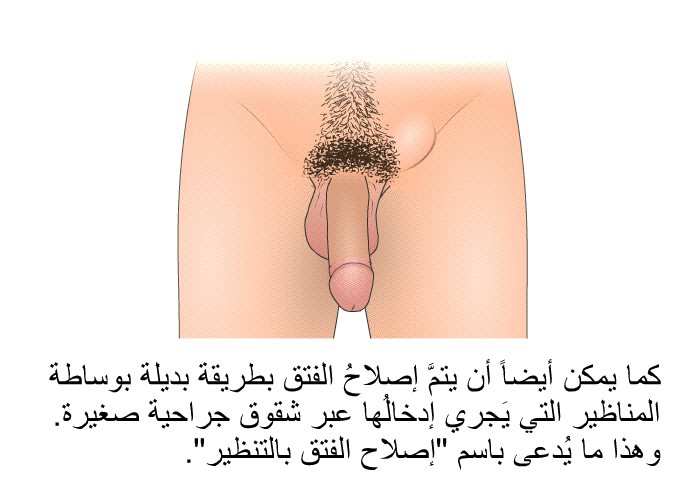 كما يمكن أيضاً أن يتمَّ إصلاحُ الفتق بطريقة بديلة بوساطة المناظير التي يَجري إدخالُها عبر شقوق جراحية صغيرة. وهذا ما يُدعى باسم "إصلاح الفتق بالتنظير".