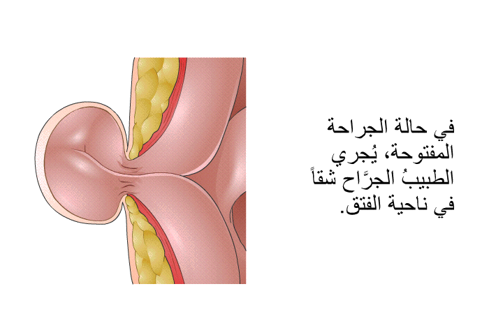 في حالة الجراحة المفتوحة، يُجري الطبيبُ الجرَّاح شقاً في ناحية الفتق.