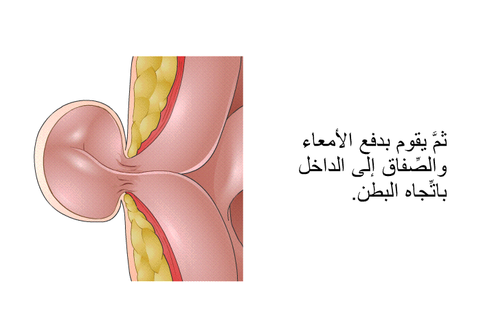 ثمَّ يقوم بدفع الأمعاء والصِّفاق إلى الداخل باتِّجاه البطن.