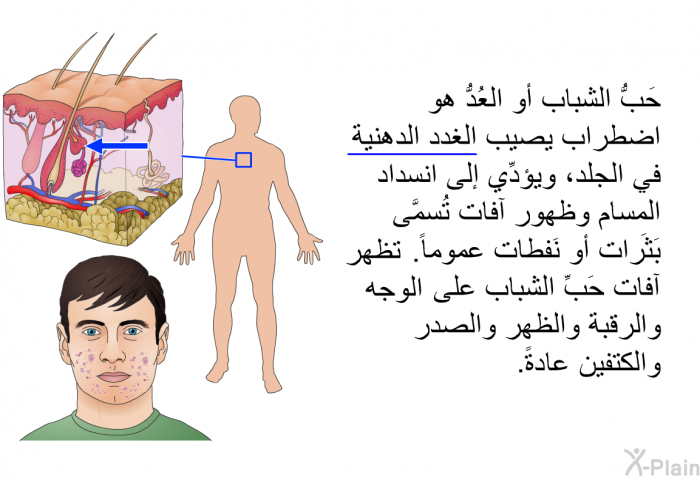 حَبُّ الشباب أو العُدُّ هو اضطراب يصيب الغدد الدهنية في الجلد، ويؤدِّي إلى انسداد المسام وظهور آفات تُسمَّى بَثَرات أو نَفطات عموماً<B>. </B>تظهر آفات حَبِّ الشباب على الوجه والرقبة والظهر والصدر والكتفين عادةً<B>. </B>