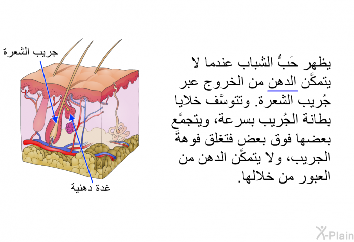 يظهر حَبُّ الشباب عندما لا يتمكَّن الدهن من الخروج عبر جُريب الشعرة. وتتوسَّف خلايا بِطانة الجُريب بسرعة، ويتجمَّع بعضها فوق بعض فتغلق فوهةَ الجريب، ولا يتمكَّن الدهن من العبور من خلالها.