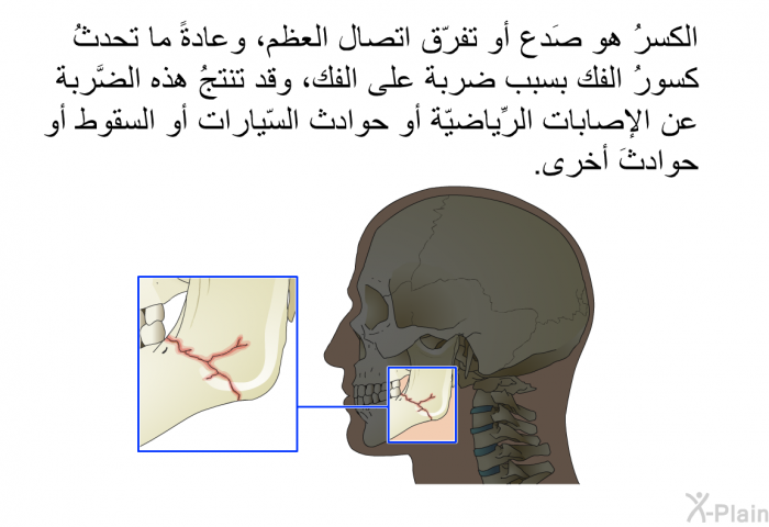 الكسرُ هو صَدع أو تفرّق اتصال العظم، وعادةً ما تحدثُ كسورُ الفك بسبب ضربة على الفك، وقد تنتجُ هذه الضَّربة عن الإصابات الرِّياضيّة أو حوادث السّيارات أو السقوط أو حوادثَ أخرى.