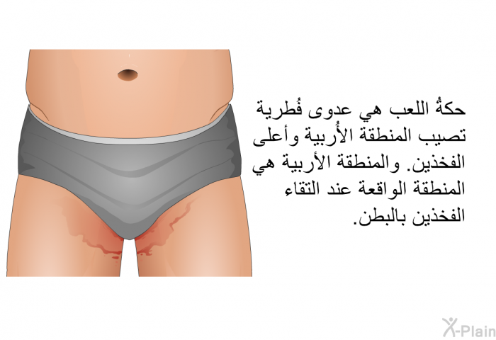 حكةُ اللعب هي عدوى فُطرية تصيب المنطقة الأُربية وأعلى الفخذين. والمنطقةُ الأربية هي المنطقة الواقعة عند التقاء الفخذين بالبطن.