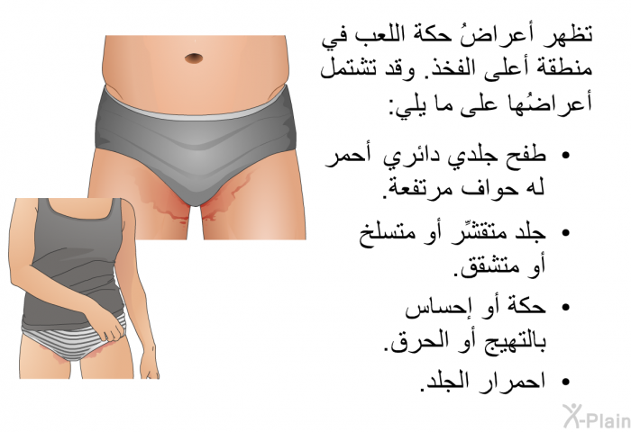 تظهر أعراضُ حكة اللعب في منطقة أعلى الفخذ. وقد تشتمل أعراضُها على ما يلي:  طفح جلدي دائري أحمر له حواف مرتفعة. جلد متقشِّر أو متسلخ أو متشقق. حكة أو إحساس بالتهيج أو الحرق. احمرار الجلد.