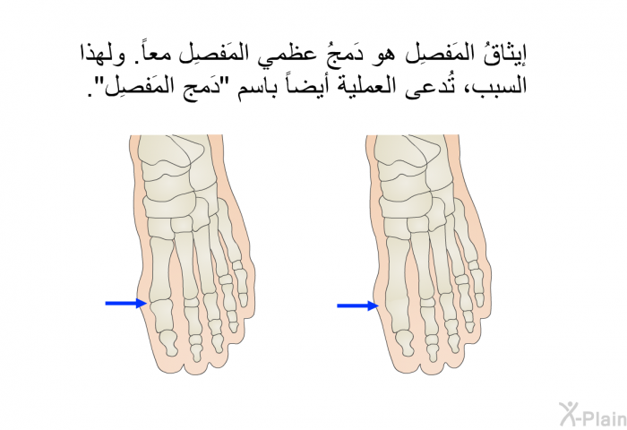 إيثاقُ المَفصِل هو دَمجُ عظمي المَفصِل معاً. ولهذا السبب، تُدعى العملية أيضاً باسم "دَمج المَفصِل".