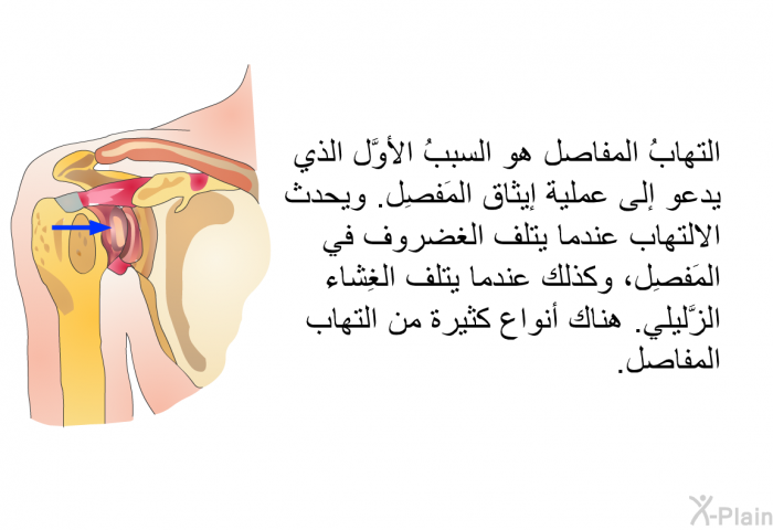 التهابُ المفاصل هو السببُ الأوَّل الذي يدعو إلى عملية إيثاق المَفصِل. ويحدث الالتهاب عندما يتلف الغضروف في المَفصِل، وكذلك عندما يتلف الغِشاء الزَّليلي. هناك أنواع كثيرة من التهاب المفاصل.