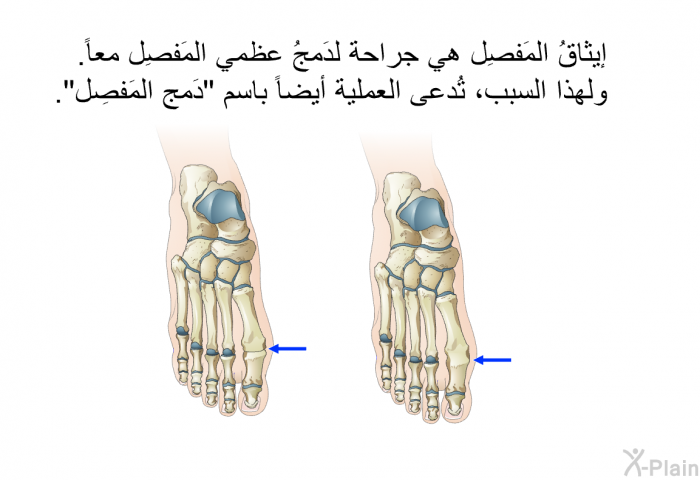 إيثاقُ المَفصِل هي جراحة لدَمجُ عظمي المَفصِل معاً. ولهذا السبب، تُدعى العملية أيضاً باسم "دَمج المَفصِل".