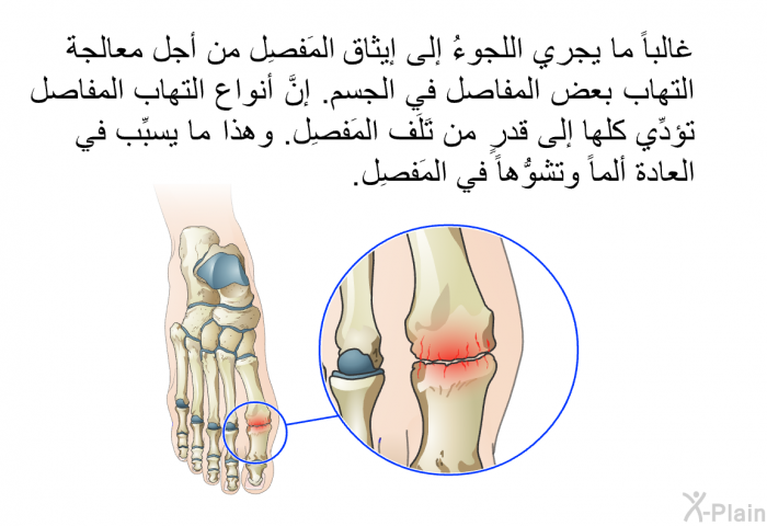 غالباً ما يجري اللجوءُ إلى إيثاق المَفصِل من أجل معالجة التهاب بعض المفاصل في الجسم. إنَّ أنواع التهاب المفاصل تؤدِّي كلها إلى قدرٍ من تَلَف المَفصِل. وهذا ما يسبِّب في العادة ألماً وتشوُّهاً في المَفصِل.