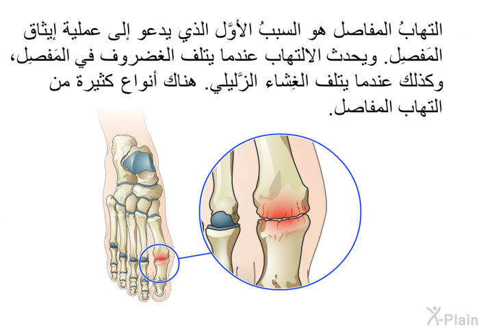 التهابُ المفاصل هو السببُ الأوَّل الذي يدعو إلى عملية إيثاق المَفصِل. ويحدث الالتهاب عندما يتلف الغضروف في المَفصِل، وكذلك عندما يتلف الغِشاء الزَّليلي. هناك أنواع كثيرة من التهاب المفاصل.