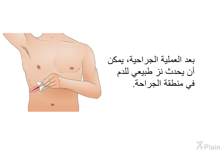بعد العملية الجراحية، يمكن أن يحدث نز طبيعي للدم في منطقة الجراحة<B>.</B>