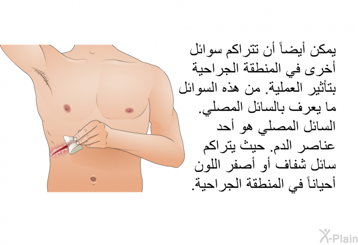 يمكن أيضاً أن تتراكم سوائل أخرى في المنطقة الجراحية بتأثير العملية<B>. </B>من هذه السوائل ما يعرف بالسائل المصلي<B>. </B>السائل المصلي هو أحد عناصر الدم<B>. </B>حيث يتراكم سائل شفاف أو أصفر اللون أحياناً في المنطقة الجراحية<B>. </B>