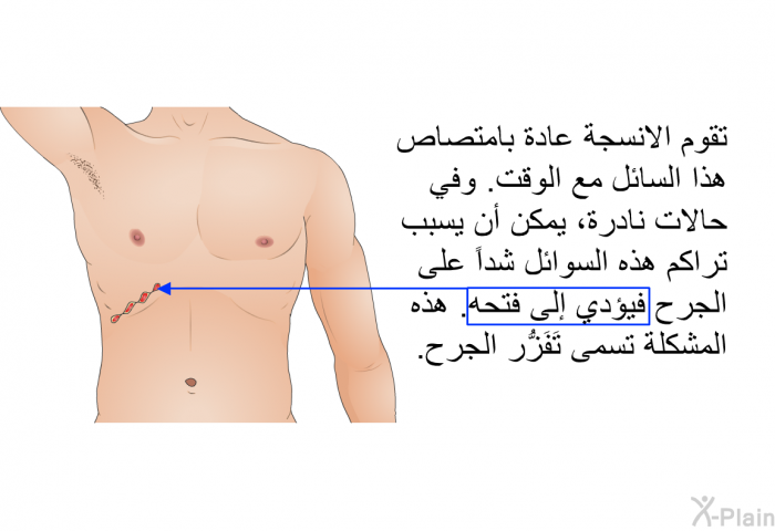 تقوم الانسجة عادة بامتصاص هذا السائل مع الوقت<B>. </B>وفي حالات نادرة، يمكن أن يسبب تراكم هذه السوائل شداً على الجرح فيؤدي إلى فتحه<B>. </B>هذه المشكلة تسمى تَفَزُّر الجرح<B>. </B>