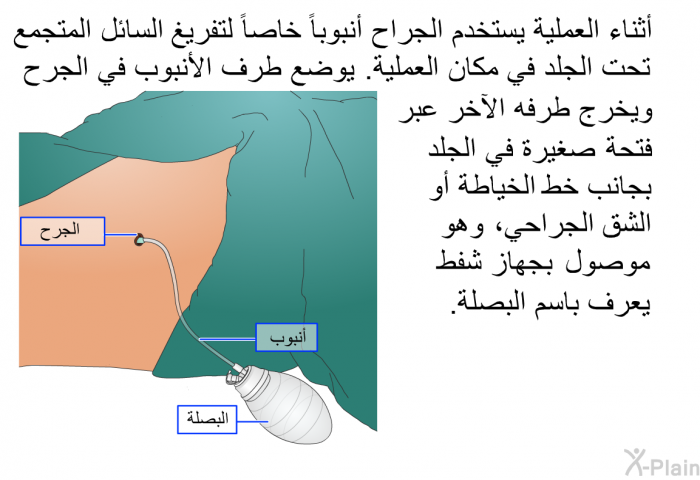 أثناء العملية يستخدم الجراح أنبوباً خاصاً لتفريغ السائل المتجمع تحت الجلد في مكان العملية<B>. </B>يوضع طرف الأنبوب في الجرح ويخرج طرفه الآخر عبر فتحة صغيرة في الجلد بجانب خط الخياطة أو الشق الجراحي، وهو موصول بجهاز شفط يعرف باسم البصلة<B>. </B>