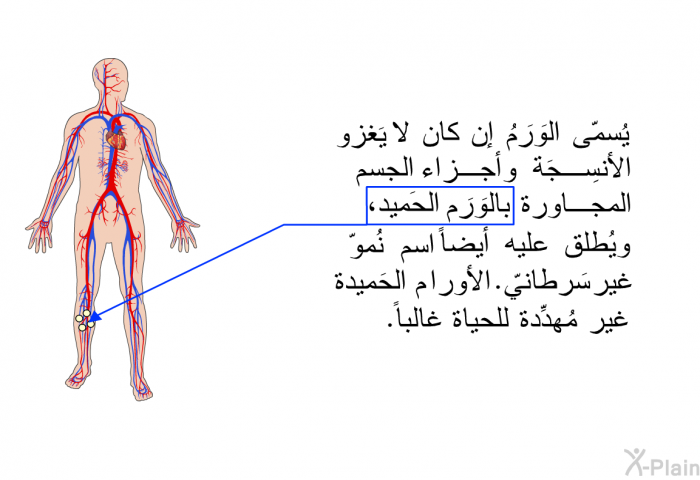 يُسمّى الوَرَمُ إن كان لا يَغزو الأنسِجَة وأجزاء الجسم المجاورة بالوَرَم الحَميد، ويُطلق عليه أيضاً اسم نُموّ غير سَرطانيّ. الأورام الحَميدة غير مُهدِّدة للحياة غالباً.