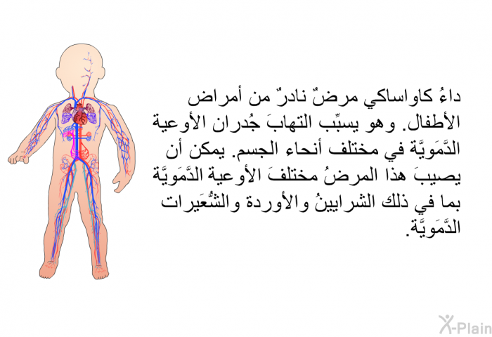 داءُ كاواساكي مرضٌ نادرٌ من أمراض الأطفال. وهو يسبِّب التهابَ جُدران الأوعية الدَّمَويَّة في مختلف أنحاء الجسم. يمكن أن يصيبَ هذا المرضُ مختلفَ الأوعية الدَّمَويَّة، بما في ذلك الشرايينُ والأوردة والشُّعَيرات الدَّمَويَّة.