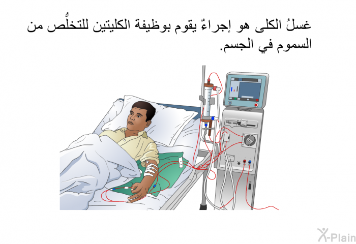 غسلُ الكلى هو إجراءٌ يقوم بوظيفة الكليتين للتخلُّص من السموم في الجسم.