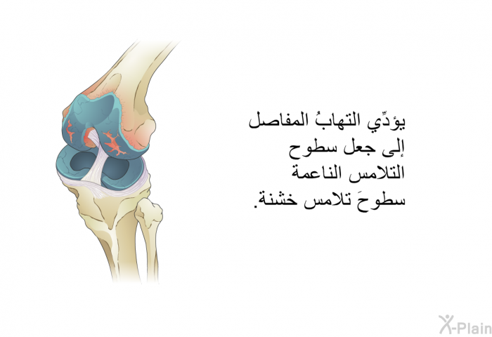 يؤدِّي التهابُ المفاصل إلى جعل سطوح التلامس الناعمة سطوحَ تلامس خشنة.