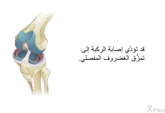 قد تؤدِّي إصابة الركبة إلى تمزُّق الغضروف المفصلي.