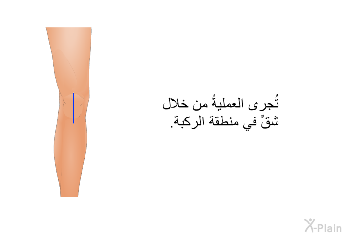 تُجرى العمليةُ من خلال شقٍّ في منطقة الركبة.