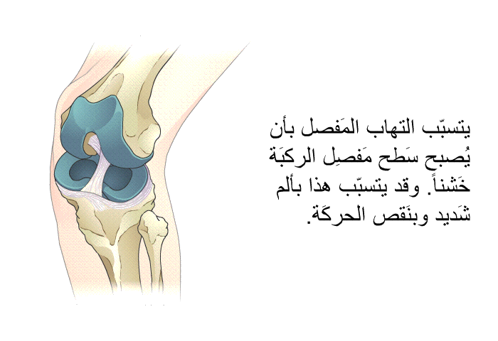 يتسبّب التهاب المَفصل بأن يُصبح سَطح مَفصِل الركبَة خَشناً. وقد يتسبّب هذا بألم شَديد وبنَقص الحركَة.