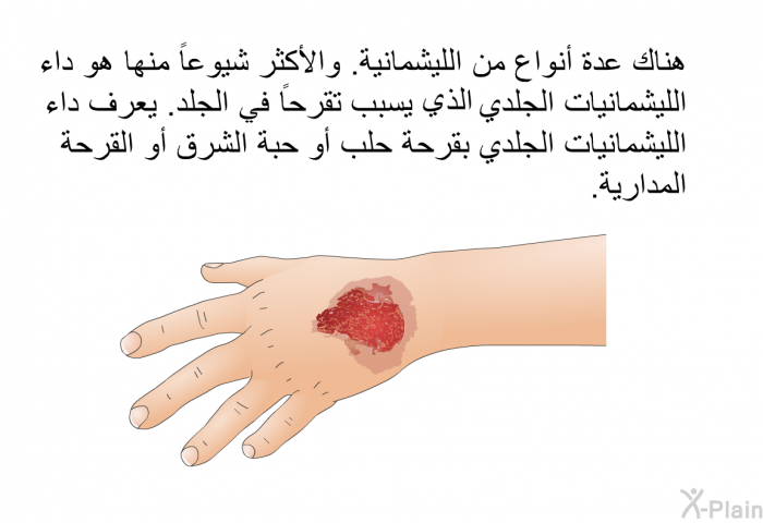 هناك عدة أنواع من الليشمانية. والأكثر شيوعا منها هو داء الليشمانيات الجلدي التي تسبب تقرحاً في الجلد. يعرف داء الليشمانيات الجلدي بقرحة حلب أو حبة الشرق أو القرحة المدارية.