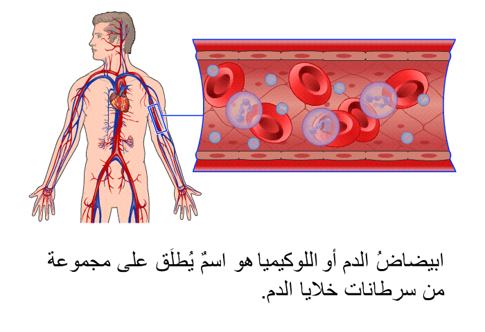 ابيضاضُ الدم هو اسمٌ يُطلَق على مجموعة من سرطانات خلايا الدم.