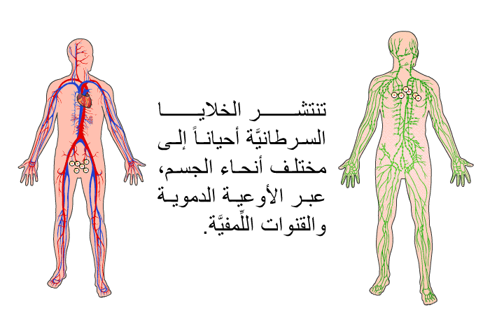 تنتشر الخلايا السرطانيَّة أحياناً إلى مختلف أنحاء الجسم، عبر الأوعية الدموية والقنوات اللِّمفيَّة.