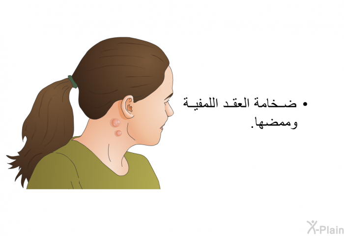 ضخامة العقد اللمفية وممضها.