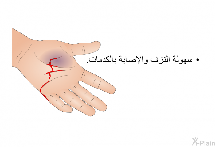 سهولة النزف والإصابة بالكدمات.